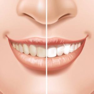 برداشتن پلاک از روی دندان ها | نخ دندان مینا