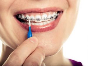 استفاده از مسواک ارتودنسی برای تمیز کردن دندان ارتودنسی شده | نخ دندان مینا