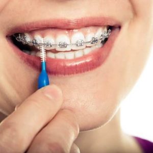 استفاده از مسواک ارتودنسی برای تمیز کردن دندان ارتودنسی شده | نخ دندان مینا