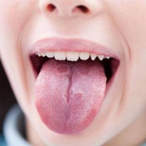 بررسی بیماری زبان لوکوپلاکیا | شرکت نخ دندان مینا