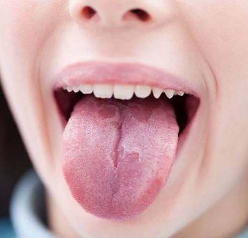 بررسی بیماری زبان لوکوپلاکیا | شرکت نخ دندان مینا