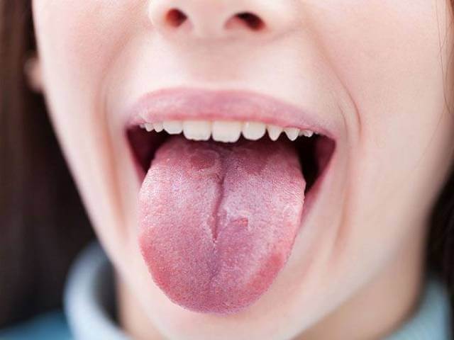 بررسی بیماری زبان لوکوپلاکیا | شرکت نخ دندان مینا
