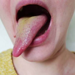 درمان بیماری زبان زرد | شرکت نخ دندان مینا