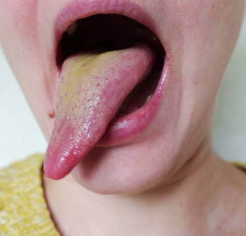 درمان بیماری زبان زرد | شرکت نخ دندان مینا