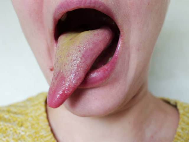 درمان بیماری زبان زرد | شرکت نخ دندان مینا