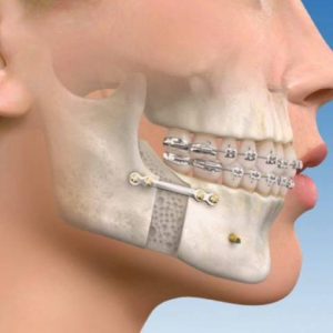 جراحی ارتوگناتیک یا جراحی اصلاحی صورت | نخ دندان مینا