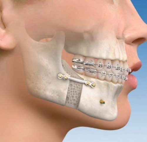 جراحی ارتوگناتیک یا جراحی اصلاحی صورت | نخ دندان مینا