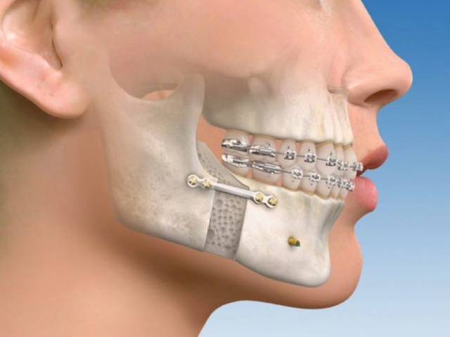 جراحی ارتوگناتیک یا جراحی اصلاحی صورت | نخ دندان مینا