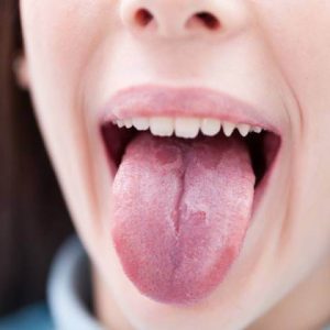 بیماری زبان قرمز یا گلوسیت| شرکت نخ دندان مینا