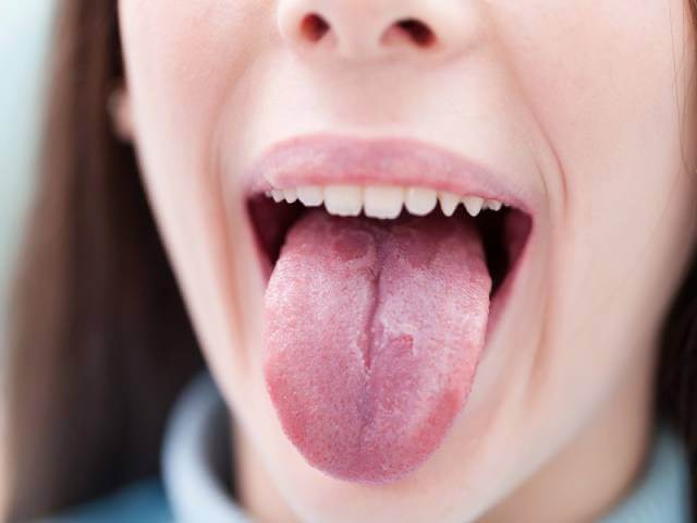 بیماری زبان قرمز یا گلوسیت| شرکت نخ دندان مینا