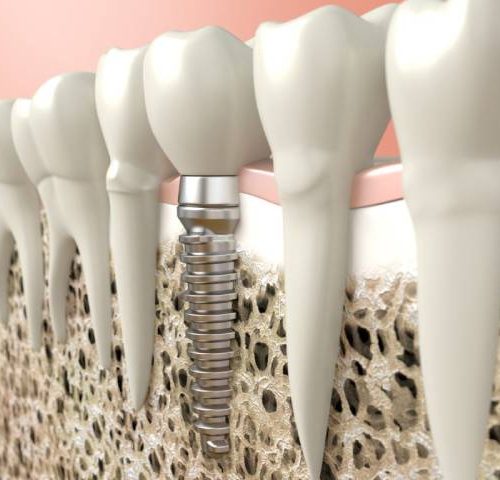 پیوند استخوان فک در ایمپلنت | نخ دندان مینا