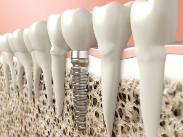 پیوند استخوان فک در ایمپلنت | نخ دندان مینا