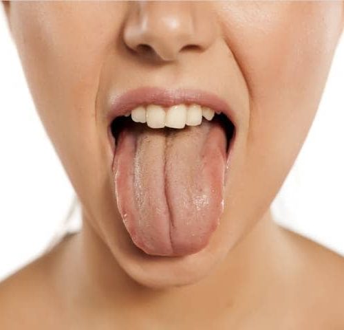درباره ی بیماری زبان اسکالوپ یا موجدار | شرکت نخ دندان مینا