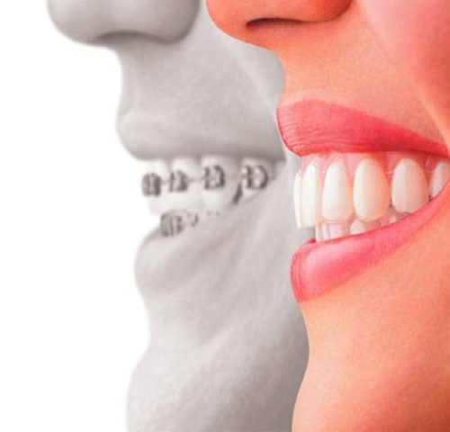 آشنایی با انواع ارتودنسی نامرئی | شرکت نخ دندان مینا
