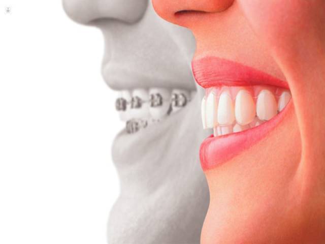 آشنایی با انواع ارتودنسی نامرئی | شرکت نخ دندان مینا
