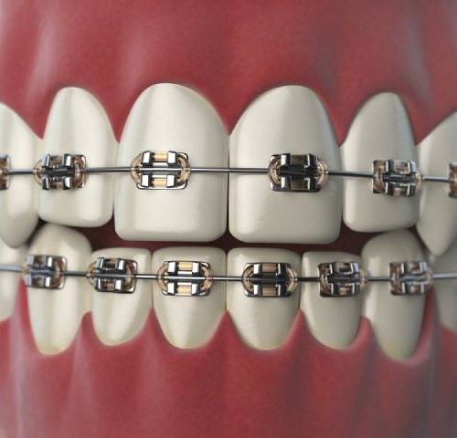 بریس دندان یا بریس ارتودنسی | شرکت نخ دندان مینا