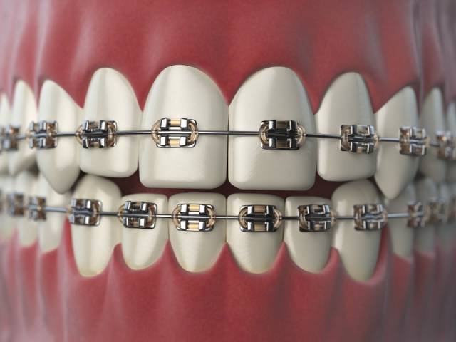 بریس دندان یا بریس ارتودنسی | شرکت نخ دندان مینا