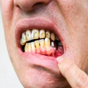 پس زدن ایمپلنت دندان و شکست درمان | شرکت نخ دندان مینا