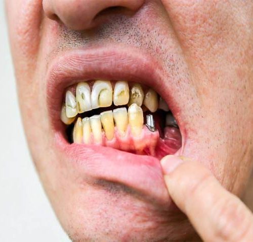 پس زدن ایمپلنت دندان و شکست درمان | شرکت نخ دندان مینا