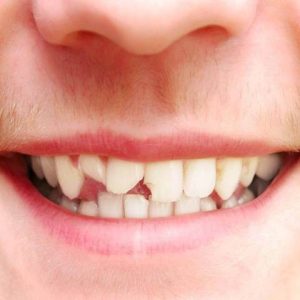 شکستگی دندان و روش های درمان آن | شرکت نخ دندان مینا