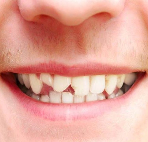 شکستگی دندان و روش های درمان آن | شرکت نخ دندان مینا