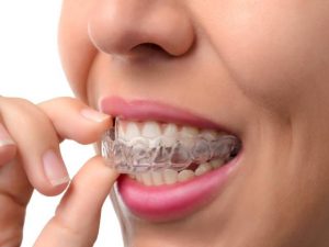 آشنایی با ریتینر ارتودنسی | شرکت نخ دندان مینا