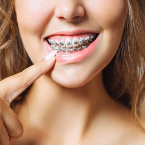 عوامل تاثیرگذار در مدت زمان ارتودنسی | شرکت نخ دندان مینا