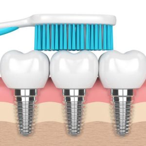مسواک زدن ؛ یکی از راه های مراقبت از دندان ایمپلنت شده | نخ دندان مینا