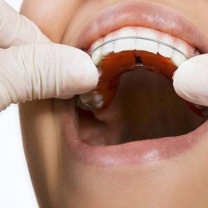 همه چیز درباره ارتودنسی فانکشنال | شرکت نخ دندان مینا