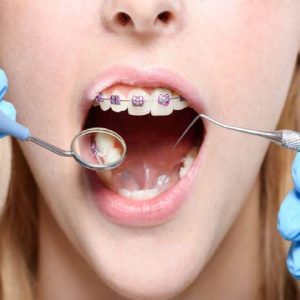 روش انجام ارتودنسی تک دندان | شرکت نخ دندان مینا