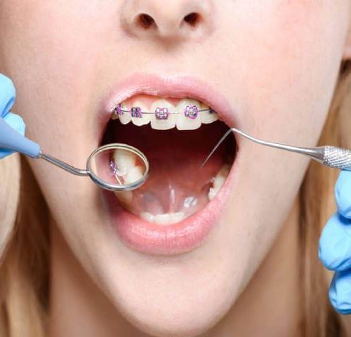 روش انجام ارتودنسی تک دندان | شرکت نخ دندان مینا