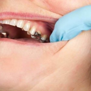 آمالگام دندان چیست؟ | شرکت نخ دندان مینا