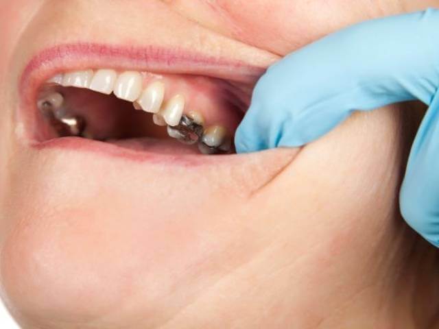 آمالگام دندان چیست؟ | شرکت نخ دندان مینا