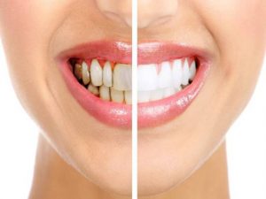 روش درمان عقب نشینی یا تحلیل لثه چیست؟ | شرکت نخ دندان مینا