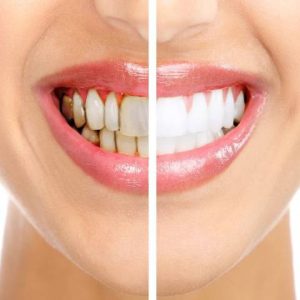 روش درمان عقب نشینی یا تحلیل لثه چیست؟ | شرکت نخ دندان مینا