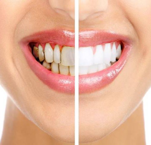 روش درمان عقب نشینی یا تحلیل لثه چیست؟ | شرکت نخ دندان مینا