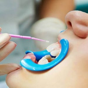 فلوراید تراپی برای چه کسانی مناسب است؟ | شرکت نخ دندان مینا