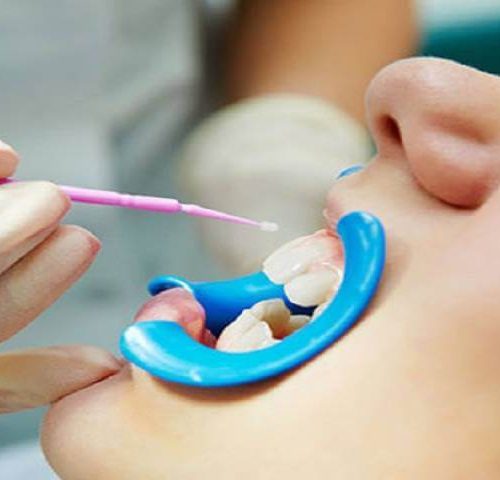 فلوراید تراپی برای چه کسانی مناسب است؟ | شرکت نخ دندان مینا