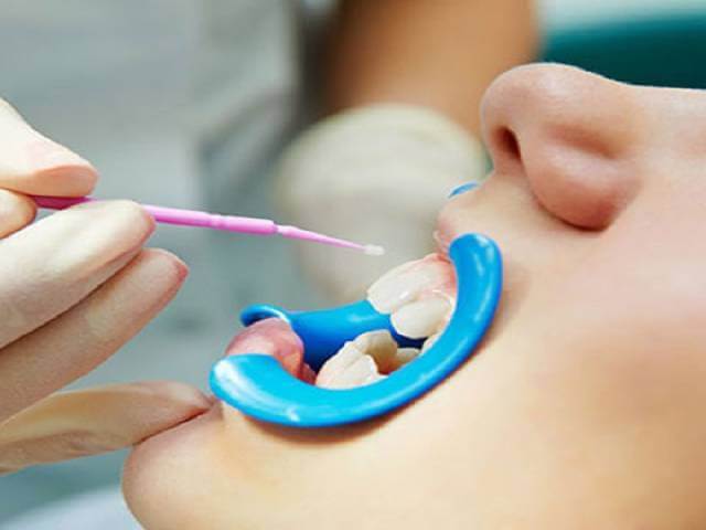 فلوراید تراپی برای چه کسانی مناسب است؟ | شرکت نخ دندان مینا