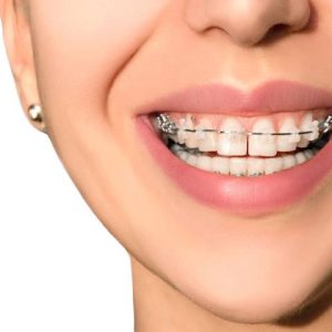 انواع ارتودنسی دندان | شرکت نخ دنذان مینا