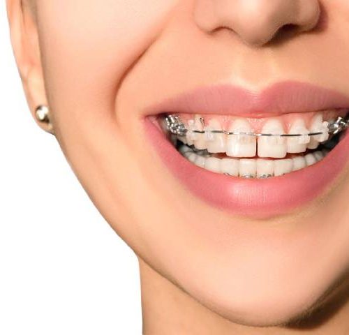 انواع ارتودنسی دندان | شرکت نخ دنذان مینا