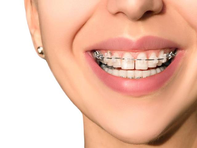 انواع ارتودنسی دندان | شرکت نخ دنذان مینا