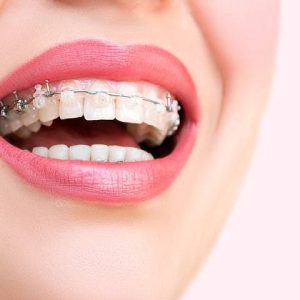 با روش ارتودنسی دیمون بیشتر آشنا شوید | شرکت نخ دندان مینا