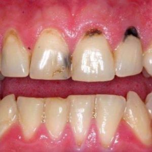 بررسی علت های سیاه شدن دندان | شرکت نخ دندان مینا