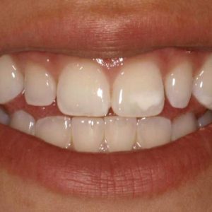 لکه های سفید دندان و راه درمان آن | شرکت نخ دندان مینا