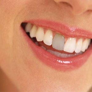 چه عواملی باعث لکه شدن دندان ها می شود؟ | شرکت نخ دندان مینا