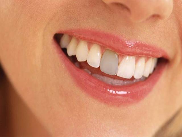 چه عواملی باعث لکه شدن دندان ها می شود؟ | شرکت نخ دندان مینا