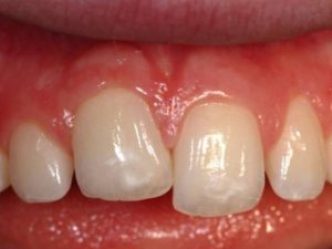 انکیلوز دندان چیست؟ | شرکت نخ دندان مینا
