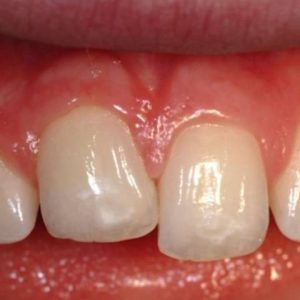انکیلوز دندان چیست؟ | شرکت نخ دندان مینا