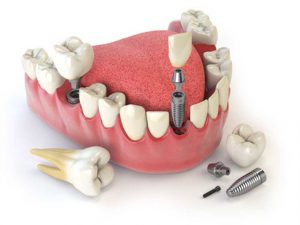 بررسی اجزای مختلف ایمپلنت دندان و کاربرد آن ها | شرکت نخ دندان مینا